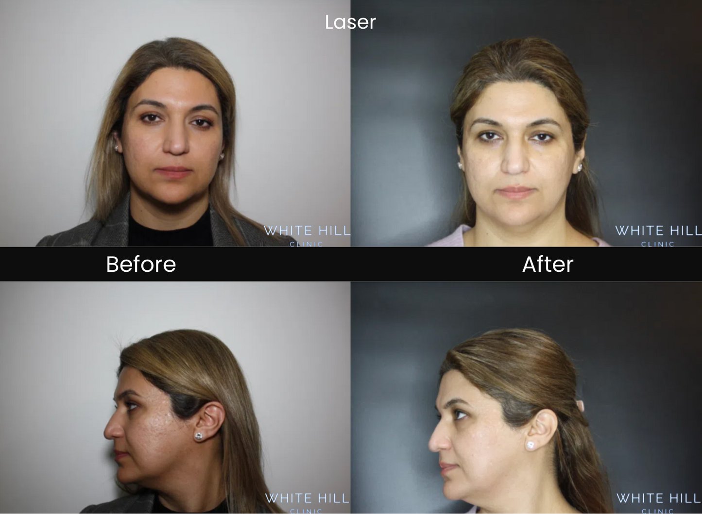 CO2 Laser Full Face & Neck Treatment