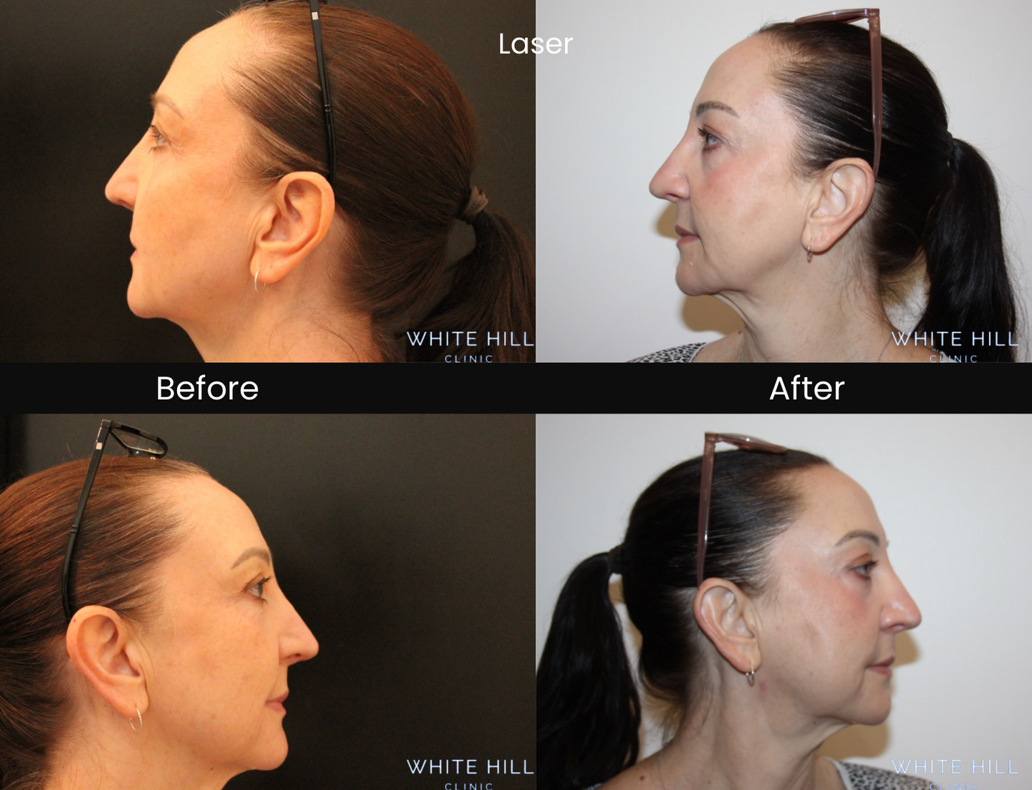 CO2 Laser Full Face & Neck Treatment