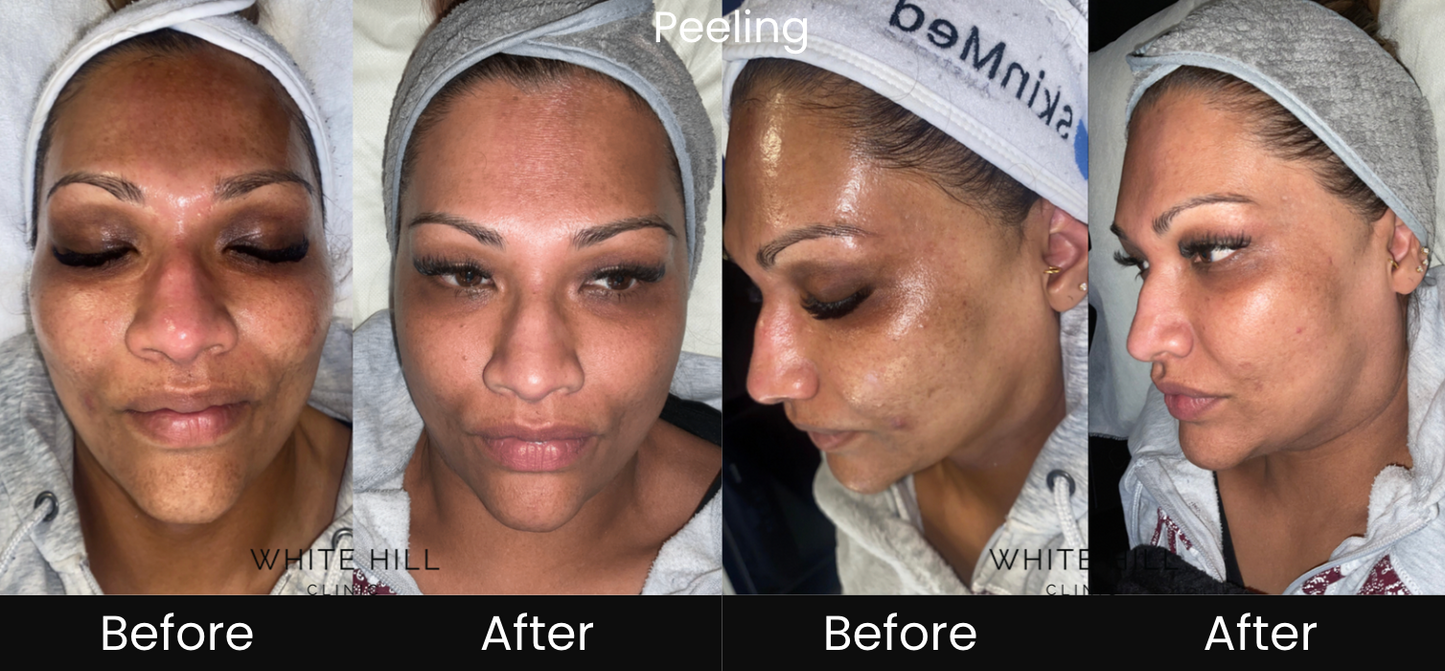 Cosmelan Intense Melasma & Pigment Removal