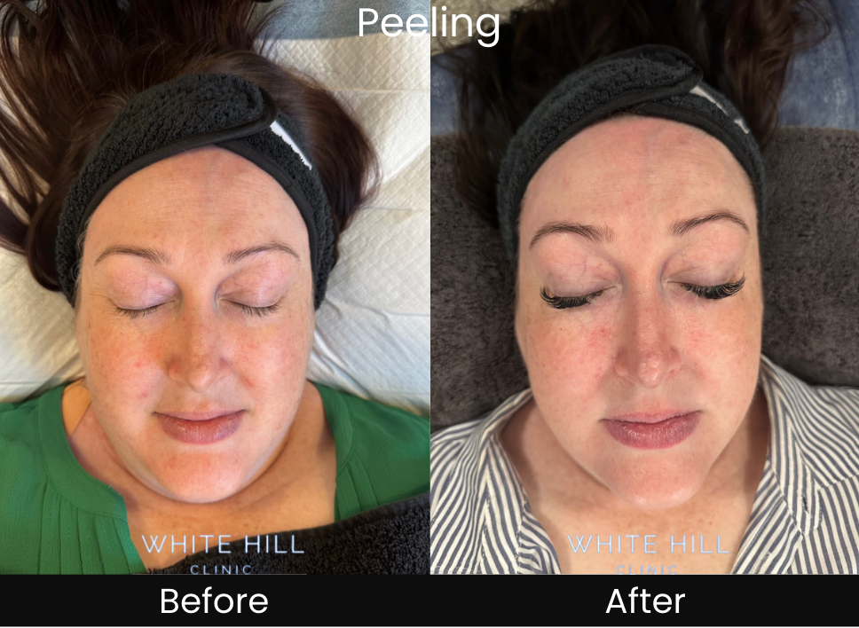Cosmelan Intense Melasma & Pigment Removal