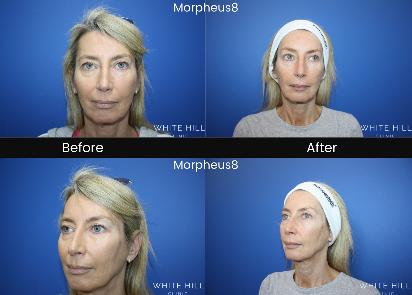 Morpheus 8 Lower Eye Lids Treatment