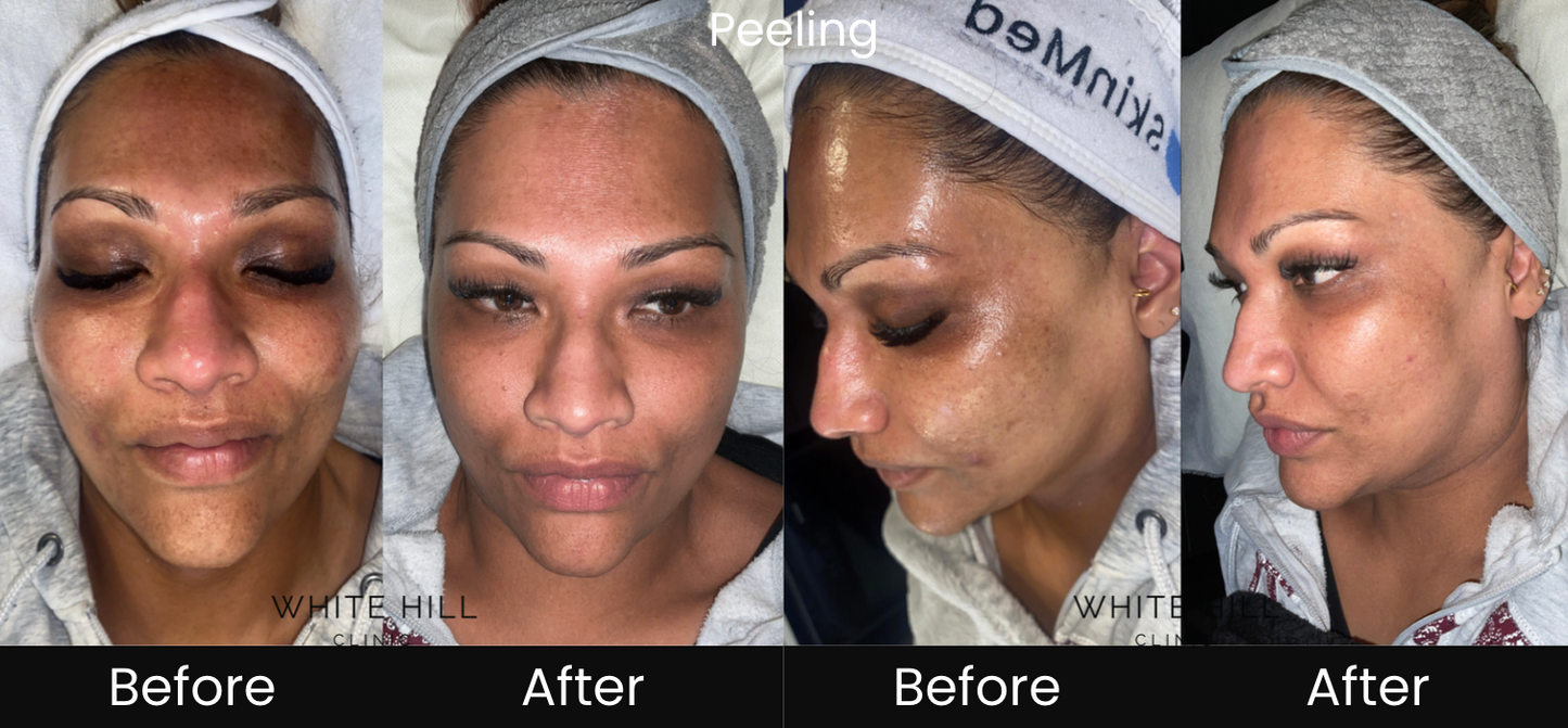 Microneedling and Peeling Face & Neck