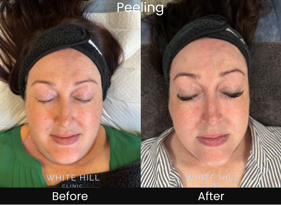 Microneedling and Peeling Face & Neck